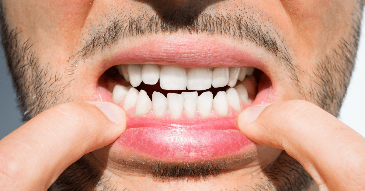Je li pomjeranje zuba normalno i šta možete učiniti?